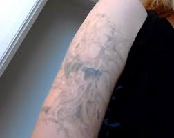 Using 16% hydrogen peroxide gel with potassium. My Experience Lightening And Removing My Tattoo At Home Tatring