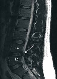 Image result for Low Back Imaging