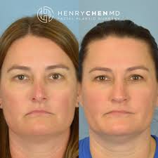 Revision Rhinoplasty, Beverly Hills Expert