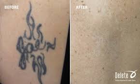 I'm hoping that reading this post will. Arm You Glad It Before After Tattoo Removal Monday Another Happy Patient S Results Using The Picoway Laser Tattoos Tattoo Removal Laser Tattoo Removal
