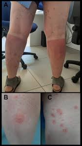 Image result for Erythema Multiforme