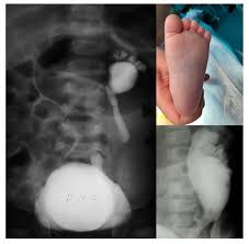 Image result for Voiding Cystourethrogram