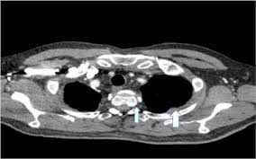 De llano urges mesothelioma cancer victims to call the number provided. Metastatic Biphasic Pleural Mesothelioma Presenting With Cauda Equina Syndrome Sciencedirect
