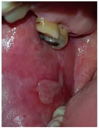 Image result for lichen planus on tongue)