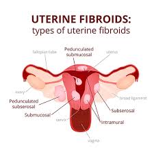 Image result for Recurrent Miscarriage