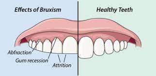 Check spelling or type a new query. How To Stop Yourself From Grinding Your Teeth At Night Mdc