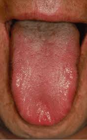 Image result for cancer of tongue