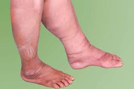 Image result for Lipodermatosclerosis