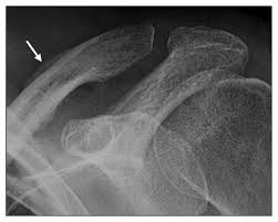 Image result for periostitis