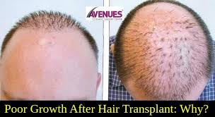 Poor Growth After Hair Transplant Why Hair Transplant Hair Doctor Hair Transplant Male