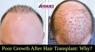 A skilled surgeon will also be able to take certain measures during hair transplant surgery to minimise this risk. Poor Growth After Hair Transplant Why Hair Doctor Hair Transplant Transplant