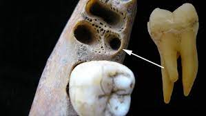 Jun 10, 2014 · best answer. Three Rooted Molars A Rare Dental Trait Lives On Cosmos Magazine