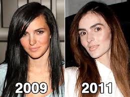Celebrity Plastic Surgery Before After 56 Pics Celebrity Plastic Surgery Plastic Surgery Plastic Surgery Fail