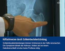 Schleimbeutelentzundung Huft Und Beckenchirurgie Endoprothetikzentrum Diakovere Annastift Diakovere