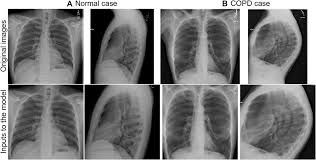 We did not find results for: Prediction Of Obstructive Lung Disease From Chest Radiographs Via Deep Copd
