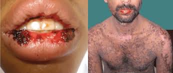 Image result for skin rash acute hiv infection