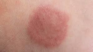 Image result for sore skin in the groin area