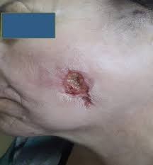 Image result for Neurotic Excoriation