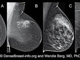 Even if you have a lump in only one breast, pictures will be taken of both breasts. Why Your Breast Density Matters Cancerconnect