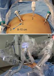 This material must not be used for commercial purposes, or in any hospital or medical facility. Robotic Approach To Cholecystectomy Intechopen