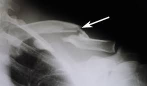 The medial ends of the clavicles should be equidistant from the spinous process at the level of t4/ t5. Clavicle Fracture Broken Collarbone Orthoinfo Aaos