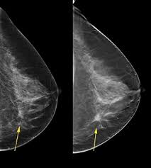 Some women may have developed breast cancer before they have their first mammogram and some may develop breast cancer between mammograms. Benefits Of 3 D Mammograms Last Over Time