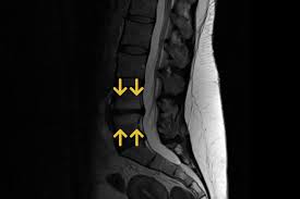 Erosive Osteochondrose Gemeinschaftspraxis Fur Neurochirurgie