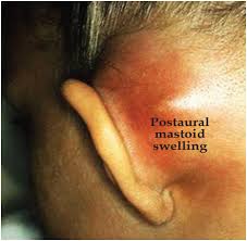 Image result for Mastoiditis