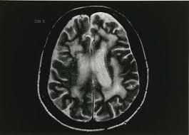 El diagnóstico precoz de la esclerosis múltiple tiene muchas. Leucoencefalopatia Multifocal Progresiva Lmp Trastornos Neurologicos Manual Msd Version Para Profesionales