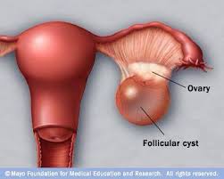 أكياس المبيض أنواعها تشخيصها Women Health Acoga د عمرو محمود خليل فيسبوك