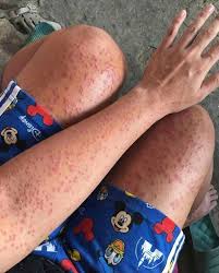 I Slept at my friends old apartment for a couple days noticed these weird  bumps all over my body.. What is this