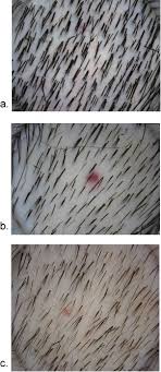 In the u.s, the type of hair loss affects 50 million men and 30 million women to some degree. Male Androgenetic Alopecia Endotext Ncbi Bookshelf
