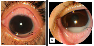 Image result for Hypopyon