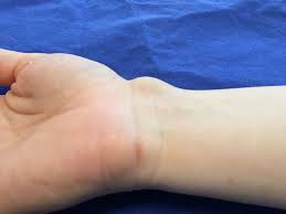 Ganglion Handgelenk Finger Uberbein Handgelenk Fingergelenk Handchirurgie Hamburg Chirurgische Praxis Alstertal