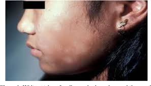 And pityriasis versicolor (tinea versicolor). An Updated Review On Pityriasis Alba Semantic Scholar