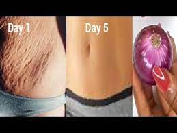 To get rid of stretch marks, apply shea butter or coconut oil to your stretch marks every day, which will hydrate your skin so your stretch marks fade. In 5 Days Remove Stretch Mark Very Fast Permanent Result Using Onion Youtube Stretch Mark Remedies Aging Skin Care Diy Stretch Mark Removal