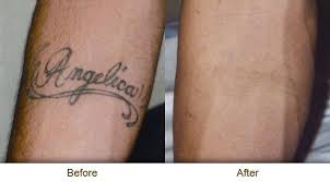 Merhaba Sizde Lazer Uygulamalarina Para Vermekten Sikilmadiniz Mi Cok Yakinda Ankara Antalya Cok Dovme Dovmemodelleri D Tattoo Dovme Sanati Dovme