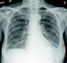 Also known as 'water on the lung,' pleural effusion occurs when liquid fills the space between the lungs and the chest wall. Abnormalities Involving The Pleura Springerlink