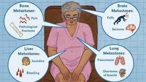 Where does lung cancer spread and how can i know if it has? Complications Of Advanced Metastatic Breast Cancer