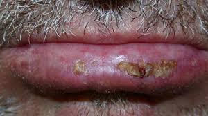 Sore in the mouth that doesn't heal (the most common symptom) white or red patch on the gums, tongue, tonsils, or lining of the mouth Mouth Cancer Symptoms Diagnosis And Treatment