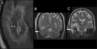 Mucormycosis is any fungal infection caused by fungi in the order mucorales. Teaching Neuroimages Brain Mri Aspects Of Isolated Cerebral Mucormycosis Neurology