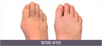 Center for minimally invasive and robotic surgery. Bunion Surgery Manhattan Nyc Best Bunion Removal Surgeon