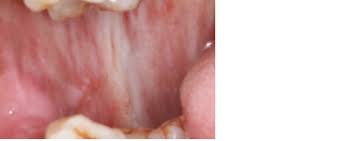 We did not find results for: Racgp Common Benign And Malignant Oral Mucosal Disease
