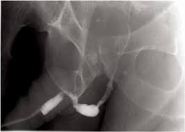 Image result for Retrograde Urethrogram