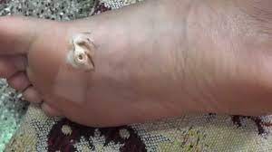 Fisheye On Foot Plantar Warts Youtube