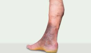Image result for Pigment stains on the shin