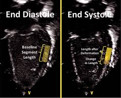 Discover what it would be like to live in the north cambridge neighborhood of cambridge, ma straight from people who live here. Deformation Imaging And Rotational Mechanics In Neonates A Guide To Image Acquisition Measurement Interpretation And Reference Values Pediatric Research