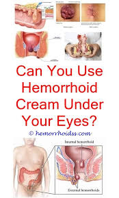 Pin On Internal Hemorrhoids Treatment