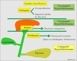 Some babies are more at risk to develop jaundice. Bilirubin Part 1 Total Bilirubin Direct And Indirect Bilirubin Classification Of Jaundice Neonatal Jaundice Labpedia Net