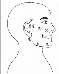 Other symptoms include drooping of the eyelid, a change in taste, and pain around the. Point Of Laser Application Used In The Treatment Of Bell S Palsy Download Scientific Diagram